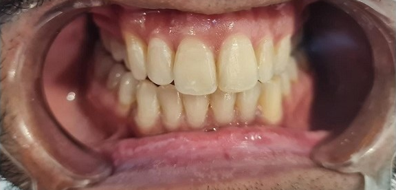 The same case after treatment
