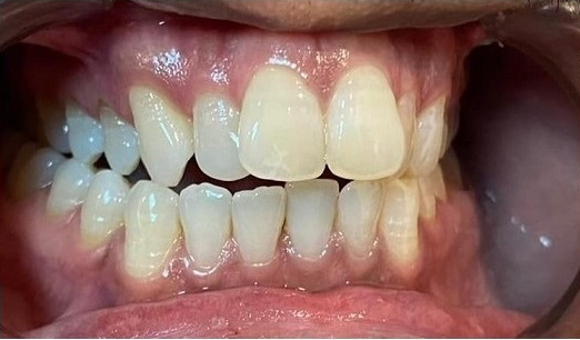 Case one before treatment