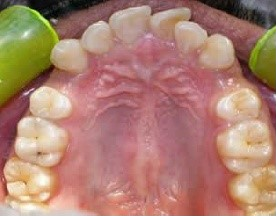 Crooked Teeth