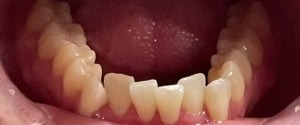 Crowded Teeth