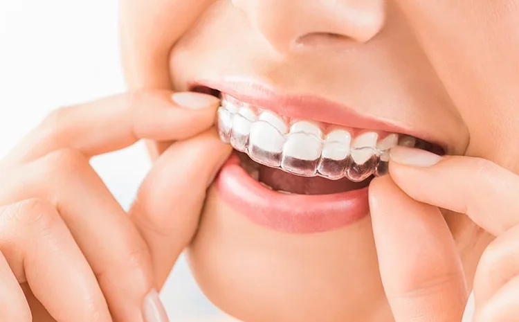 Clear aligner treatment for patients from Wapda Town