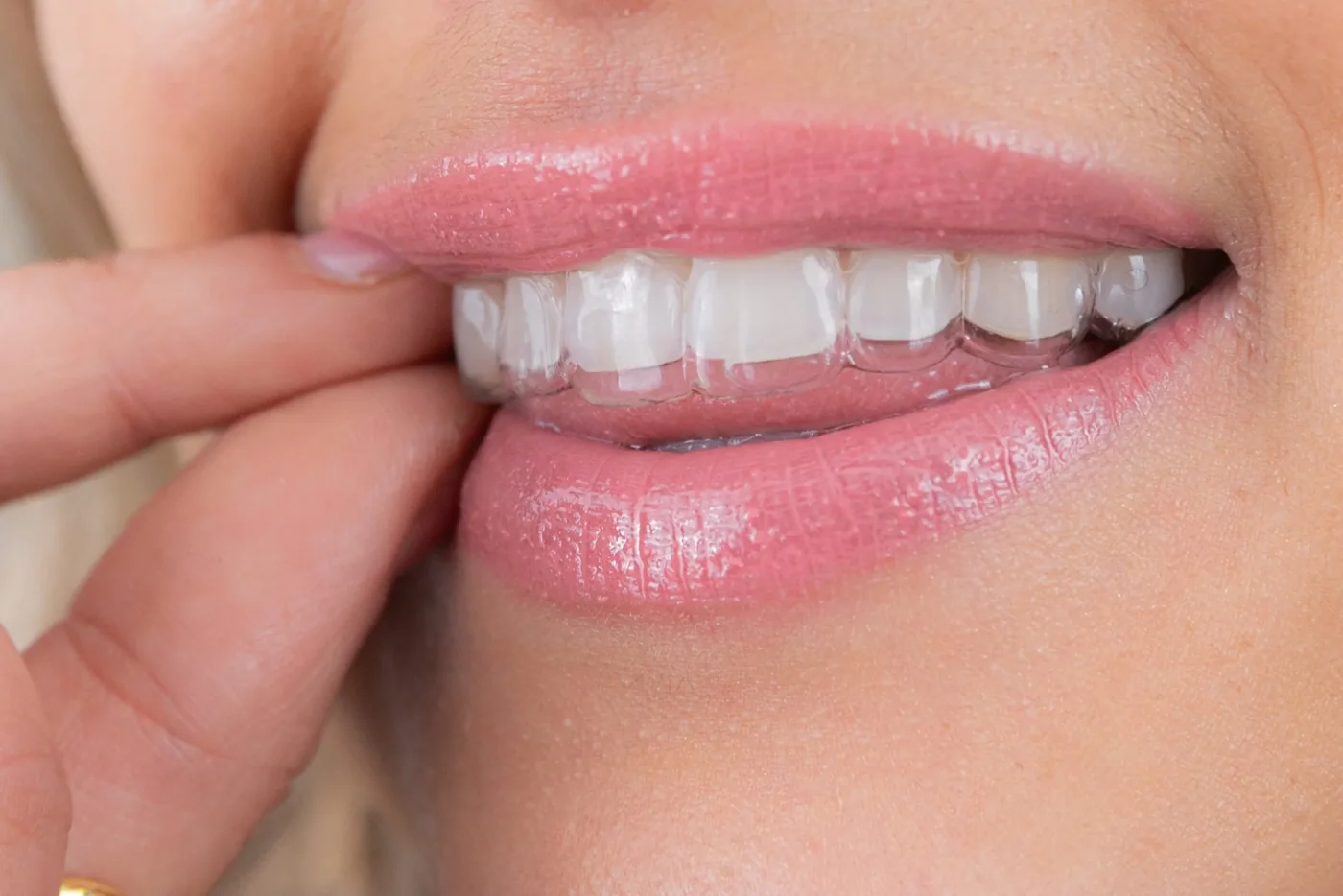 A transparent aligner fitted over the teeth