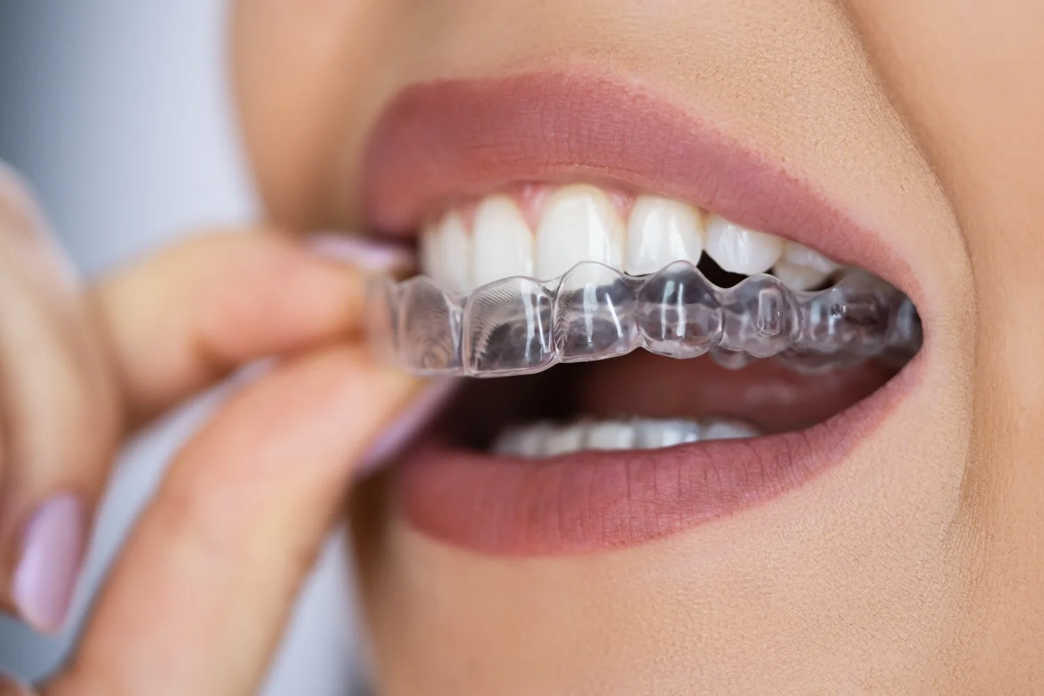Illustrative image for Teeth Aligners in Lahore, Pakistan