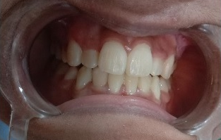 After treatment photograph for Treatment comparison 02