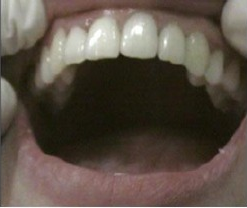 After treatment photograph for Treatment comparison 06