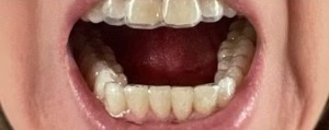 After treatment photograph for Treatment comparison 08